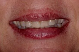 smile before