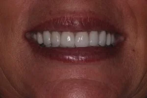 smile after