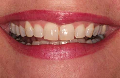 Kelly's smile before gum recontouring