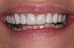 Kelly's smile after gum recontouring