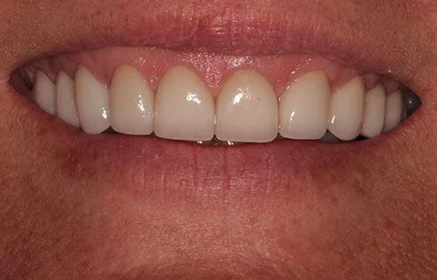 June's smile after smile makeover