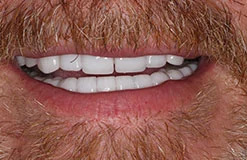 Todd Z.'s smile after smile makeover